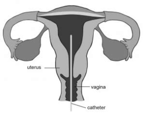 endometrial scratching procedure